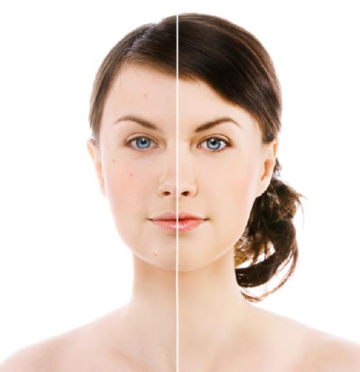 Mỹ phẩm Kem đặc trị mụn Avene TriAcneal - Photo 5 Kem đặc trị mụn Avene TriAcneal - Photo 5