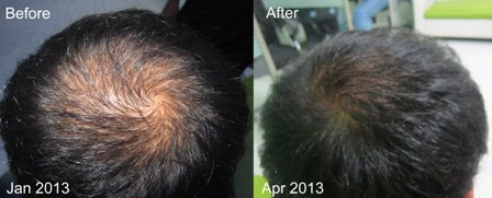 Sản phẩm Tóc Thuốc mọc tóc Kaminomoto Hair Growth Accelerator nâu đậm - Photo 6 Thuốc mọc tóc Kaminomoto - Photo 6